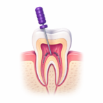 KD root Canal